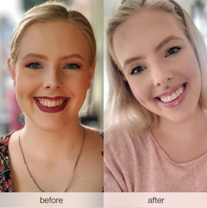 Invisalign 