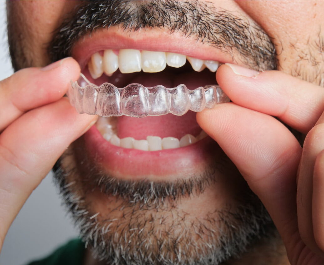 invisalign Preview Image